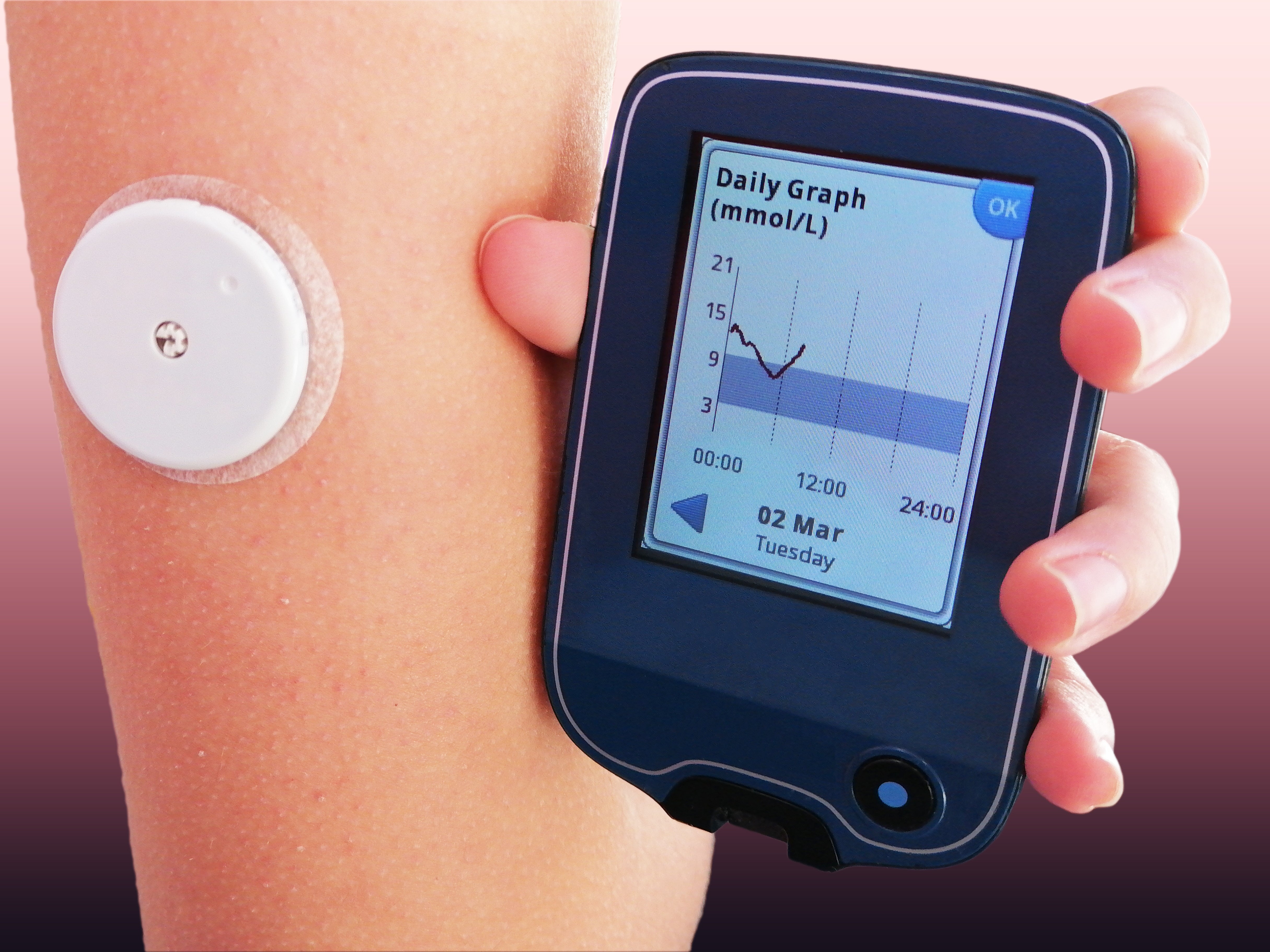 Continuous Glucose Monitoring (CGM): A Game Changer in Diabetes Care